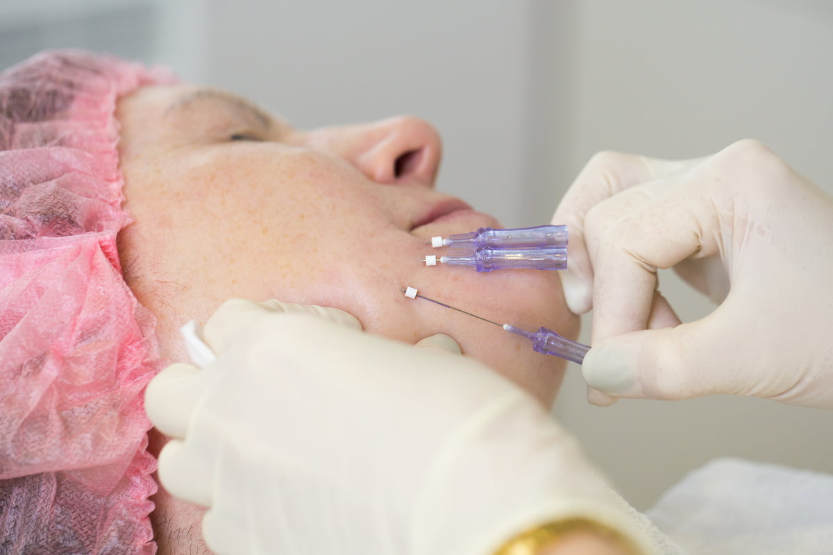 Overview of Different Thread Types at Skin Renewal Clinics